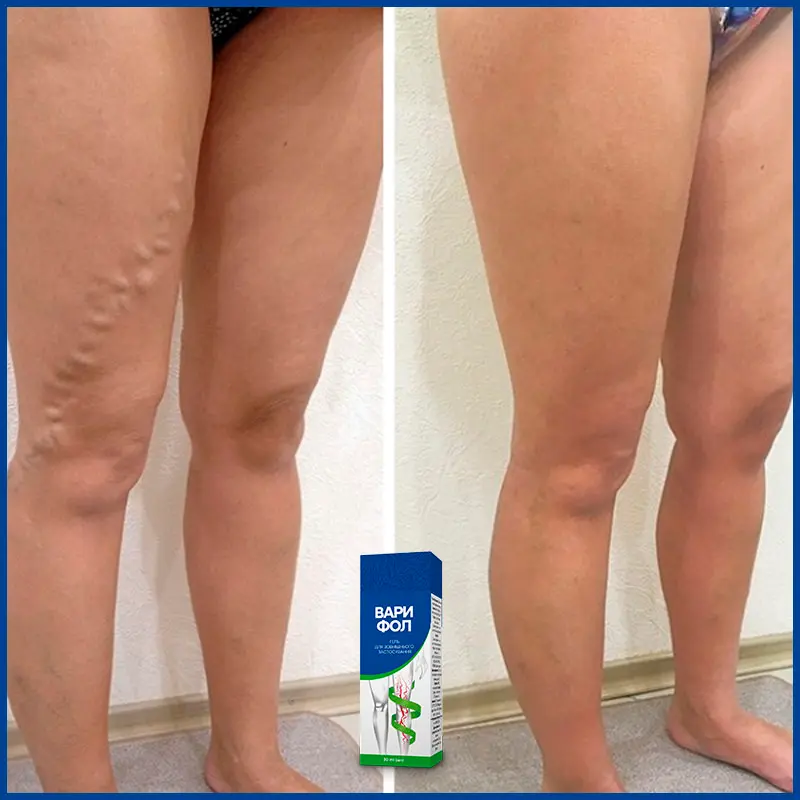Варифол відгук 1