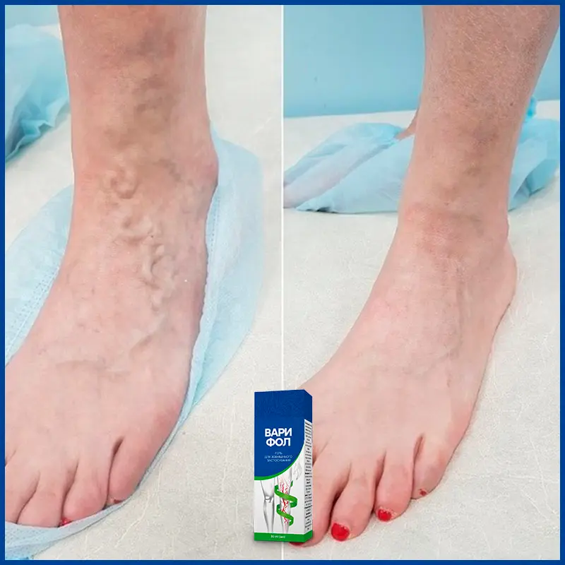 Варифол відгук 2