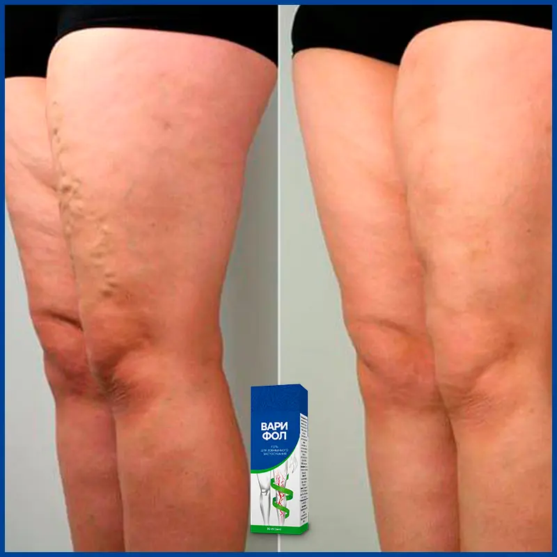 Варифол відгук 3