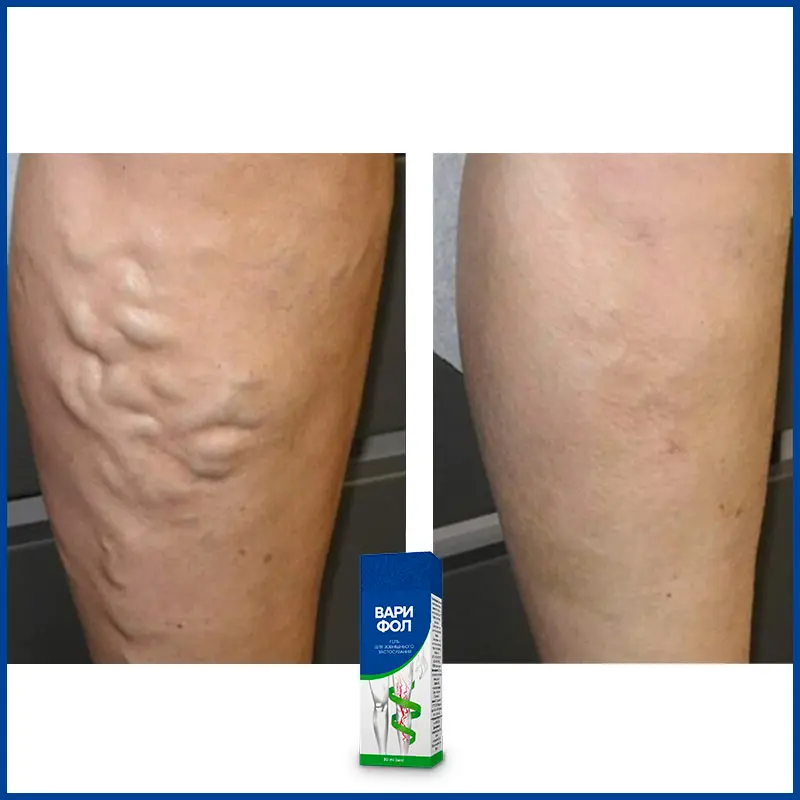 Варифол відгук 4