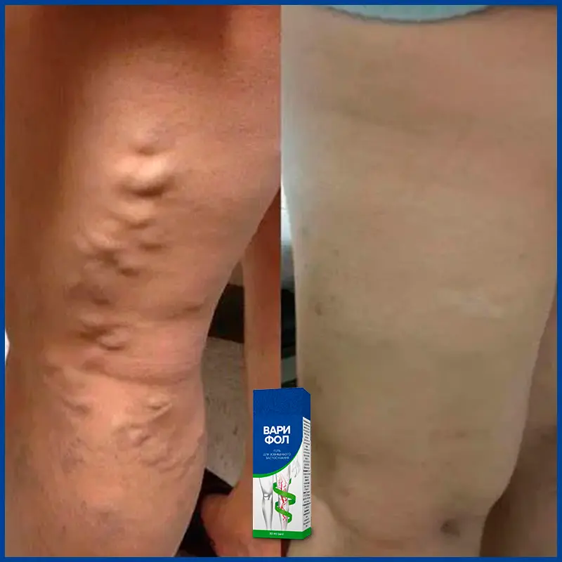 Варифол відгук 6