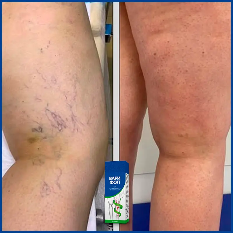 Варифол відгук 7